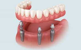 dental-implants-in-the-dominican-republic-and-cost:-affordable-smiles-abroad